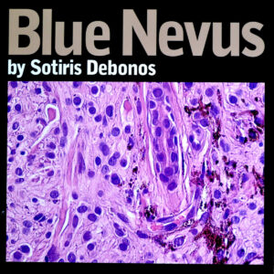 Sotiris Debonos - Blue Nevus